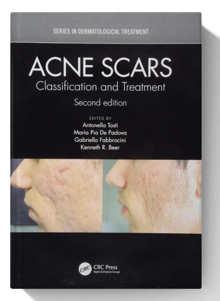 Acne Scars: Classification and Treatment, Second Edition (Series in Dermatological Treatment)