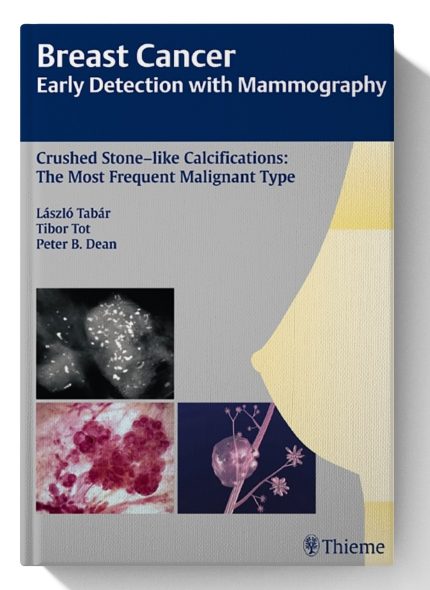 Breast Cancer: Early Detection with Mammography: Crushed Stone-like Calcifications: The Most Frequent Malignant Type (Tabar Mammo)