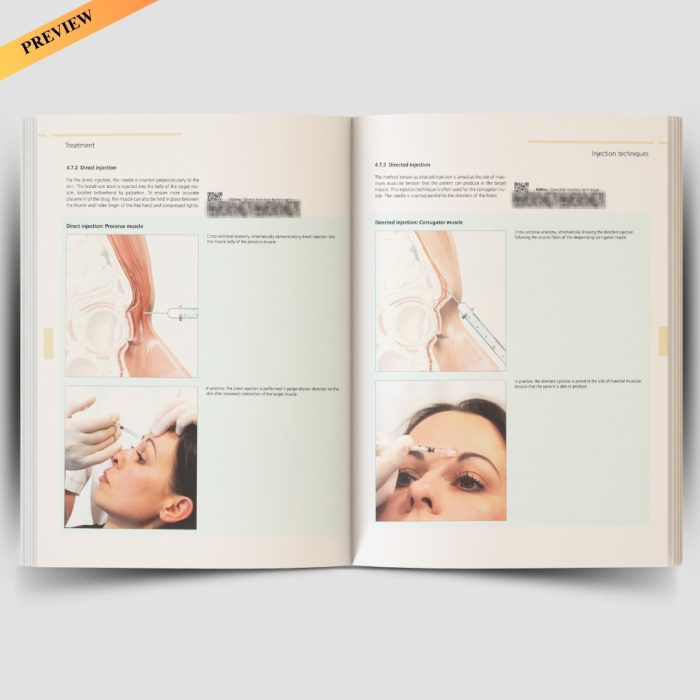 Illustrated Guide to Aesthetic Botulinum Toxin Injections: Basics / Localization / Uses (Aesthetic Methods for Skin Rejuvenation) - Image 5
