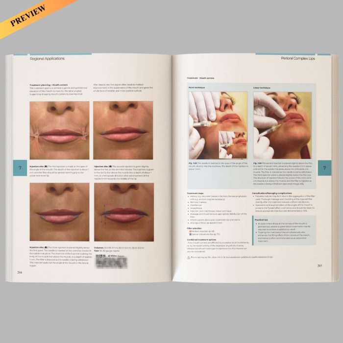 Illustrated Guide to Injectable Fillers: Basics, Indications, Uses – (High quality scanned version) - Image 5