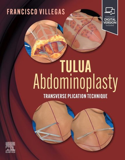TULUA Abdominoplasty - E-BOOK: Transverse Plication Technique