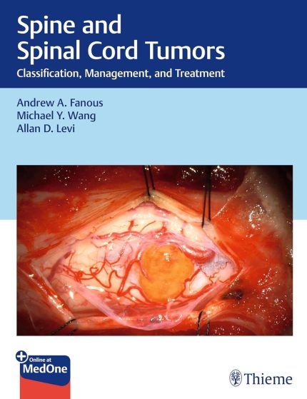 Spine and Spinal Cord Tumors: Classification, Management, and Treatment
